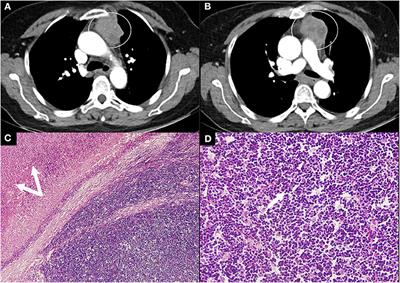 Myasthenia Gravis Coexisting With Primary Sjögren's Syndrome: Report of Three Cases and Literature Review